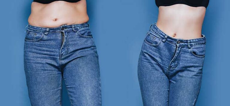 The Benefits of Abdominoplasty Surgery
